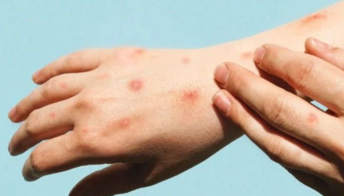 Waspada Virus Mpox, Pemerintah Tingkatkan Kewaspadaan di Bandara Soetta